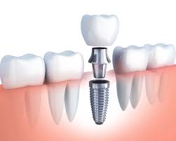 Bite Into the Future: 3D Printing's Role in Dental Implant Success